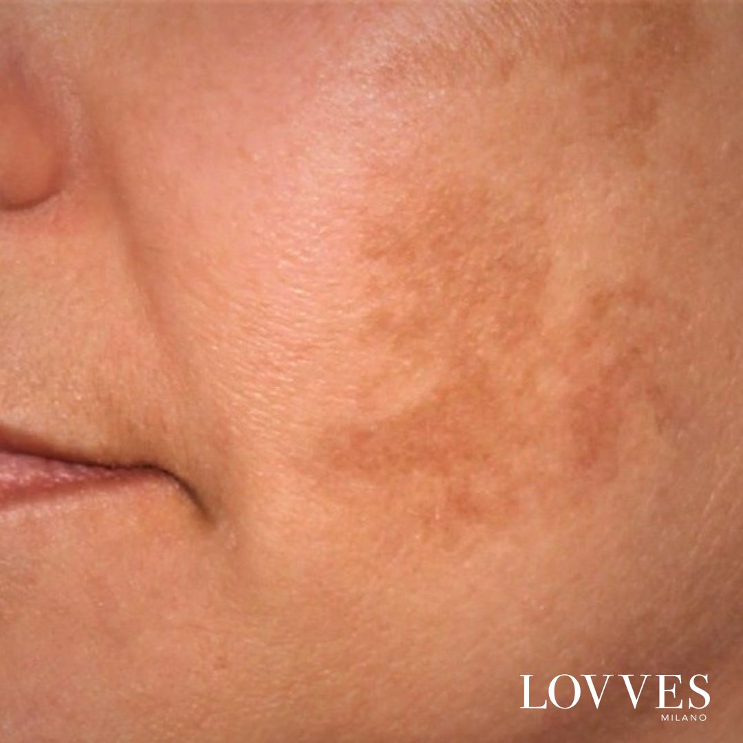 Soro Iluminador Manchas Rosto Despigmentante