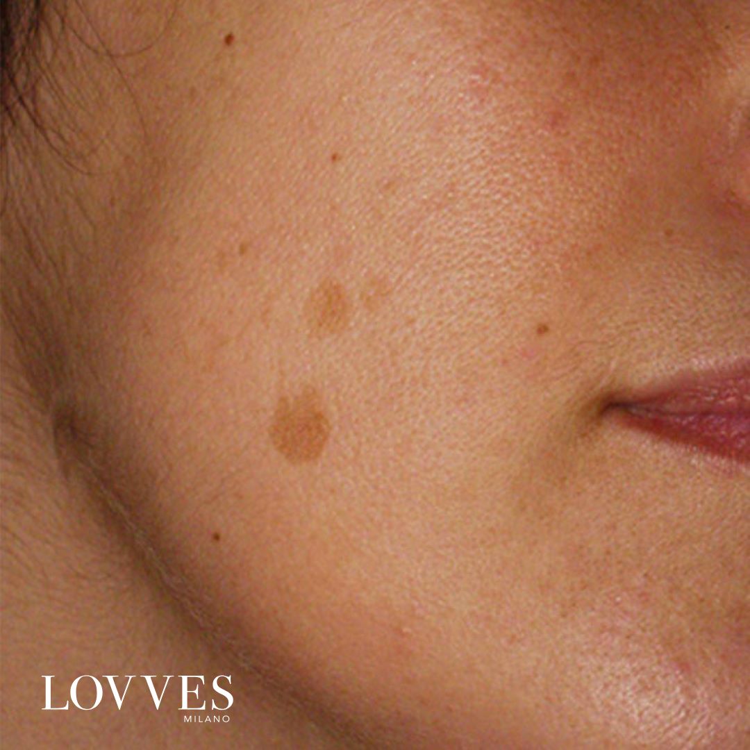 Soro Iluminador Manchas Rosto Despigmentante