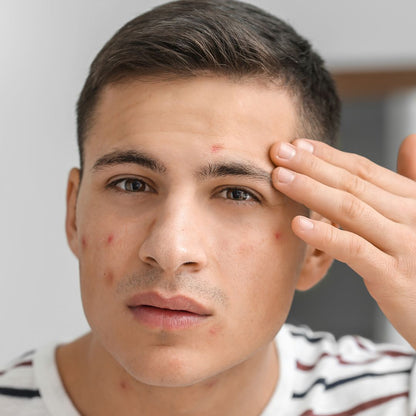 Skincare Anti Borbulhas